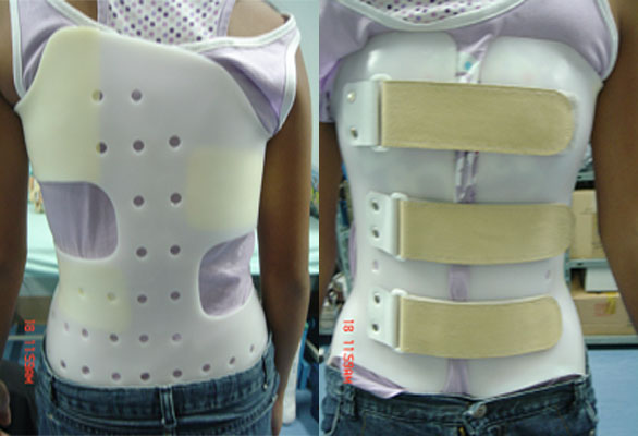 My Care Prosthetics & Orthotics Medical Center - Boston brace for scoliosis  - The Boston Brace is a plastic body jacket used in the treatment of  adolescents with idiopathic scoliosis. The Boston